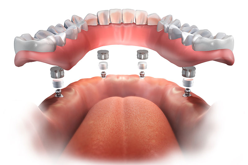 Implant Dentures in Downey