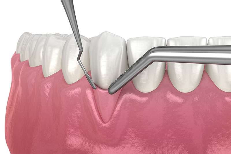 Bone Grafting in Downey