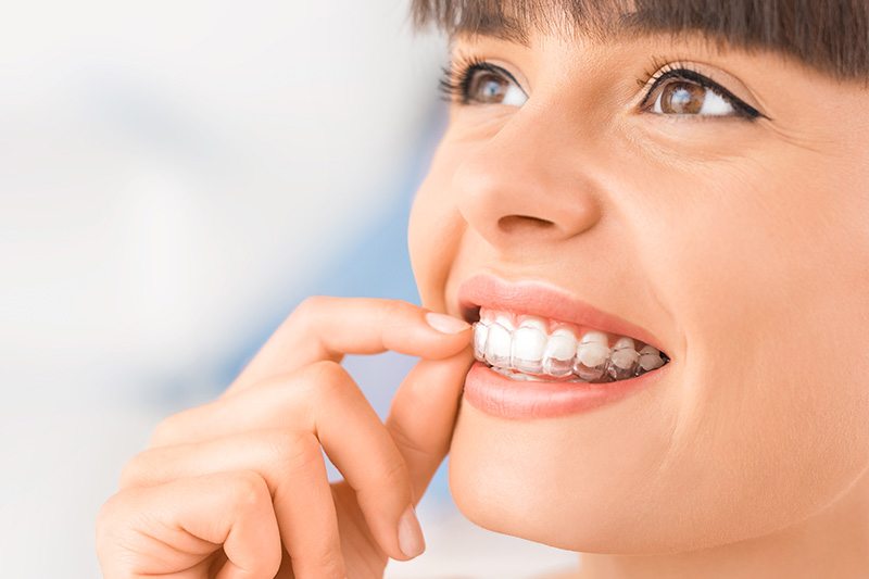 Invisalign in Downey