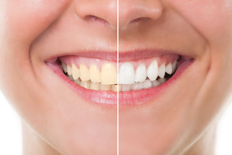 Teeth Whitening in Downey