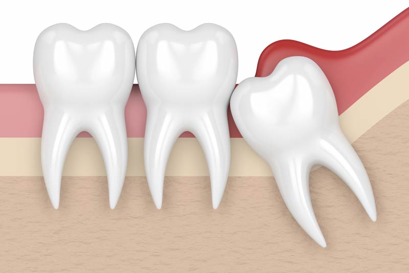 Wisdom Tooth Removal in Downey